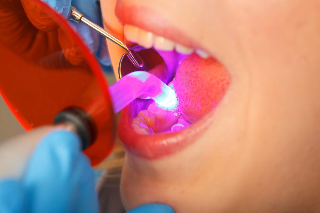 Dental Bonding in Sarasota, Florida