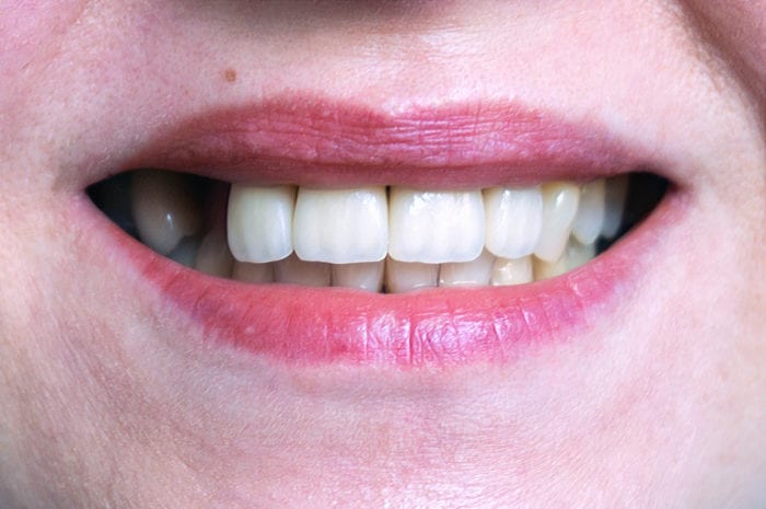 Replace Missing Teeth in Sarasota, Florida