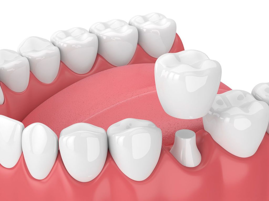 benefits of dental crown treatment