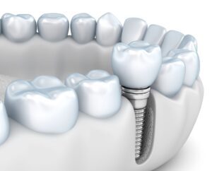 dental implants benefit jawbone health