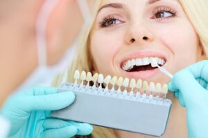 How to Care for Porcelain Veneers