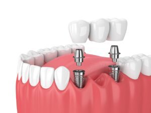 Which Dental Implants Will Restore My Smile