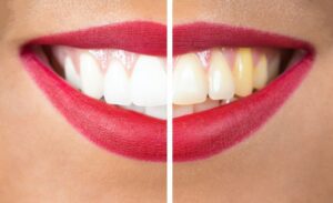 Comparing Types of Tooth Stains