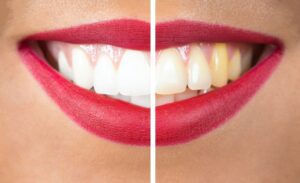 Before and after teeth whitening