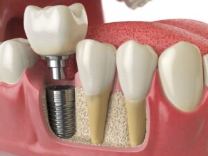 Durable Tooth Replacement with Implants