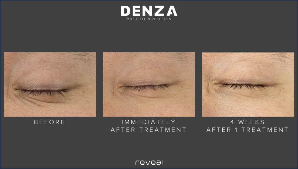 denza before and after sarasota fl