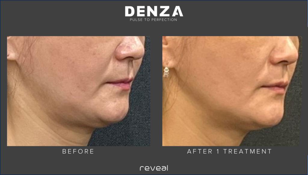 denza before and after sarasota fl