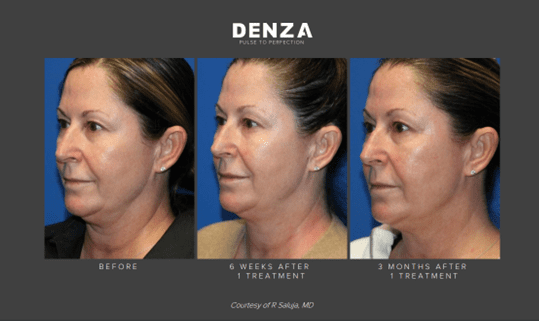 denza before and after sarasota fl
