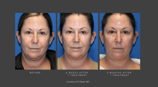 denza before and after sarasota fl