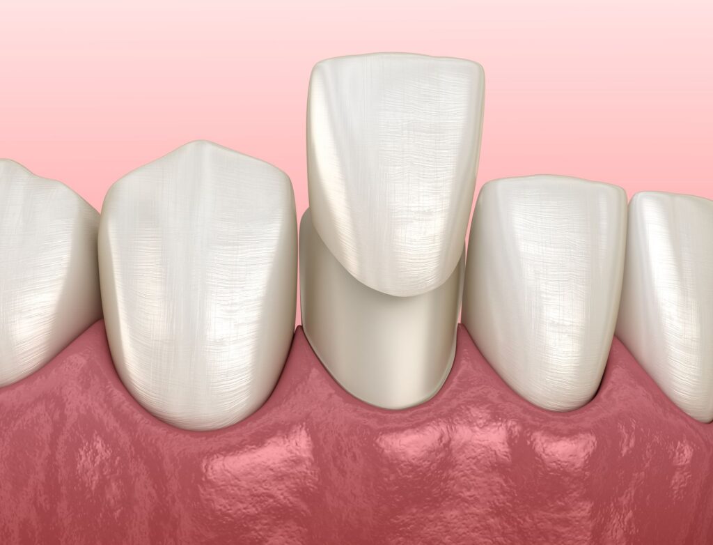 What Do Porcelain Veneers Do