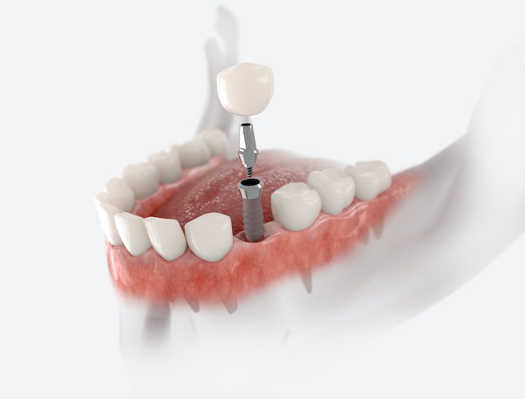 When Dentists Recommend Dental Implants
