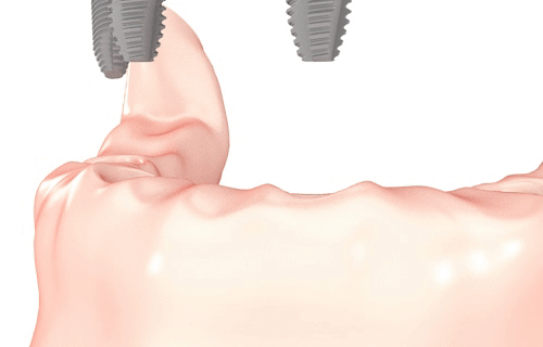 Implant-supported dentures