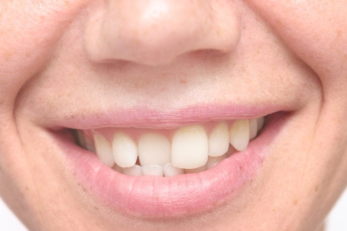 Crooked Teeth in Sarasota FL
