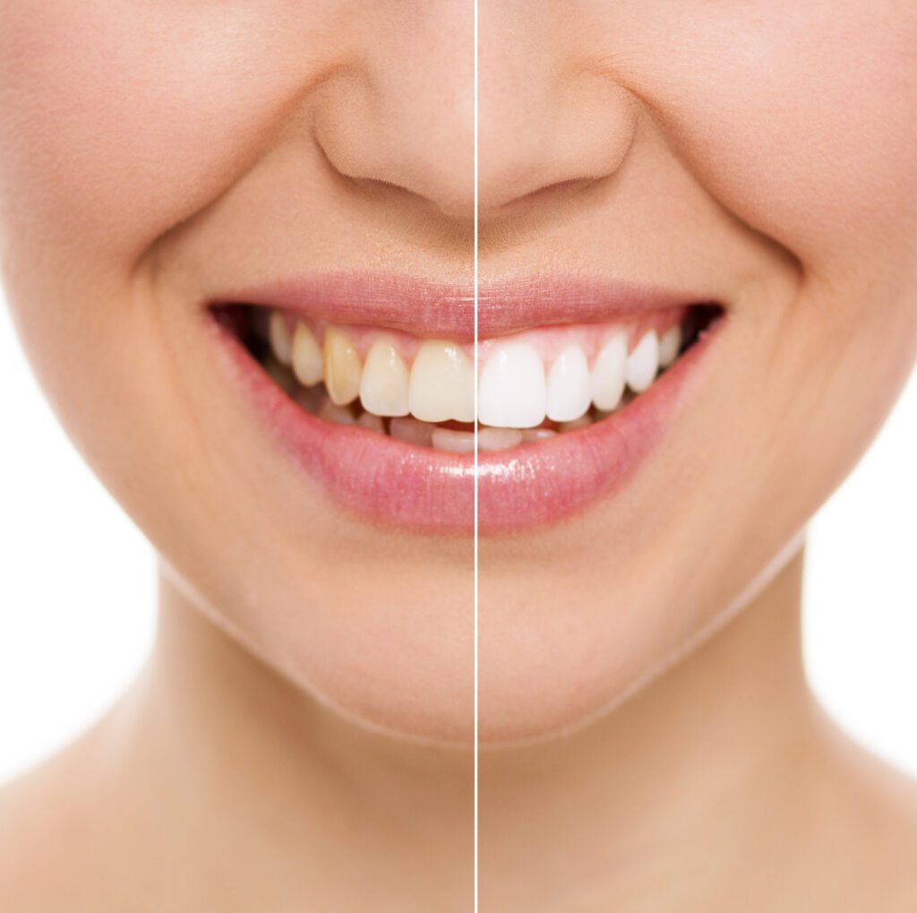 Discolored Teeth in Sarasota FL